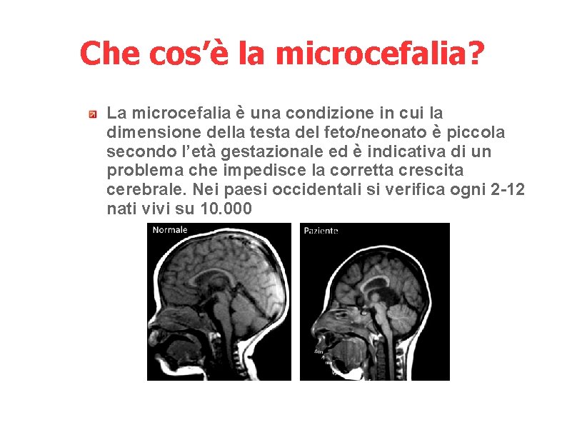 Che cos’è la microcefalia? La microcefalia è una condizione in cui la dimensione della