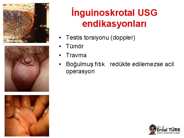 İnguinoskrotal USG endikasyonları • • Testis torsiyonu (doppler) Tümör Travma Boğulmuş fıtık redükte edilemezse