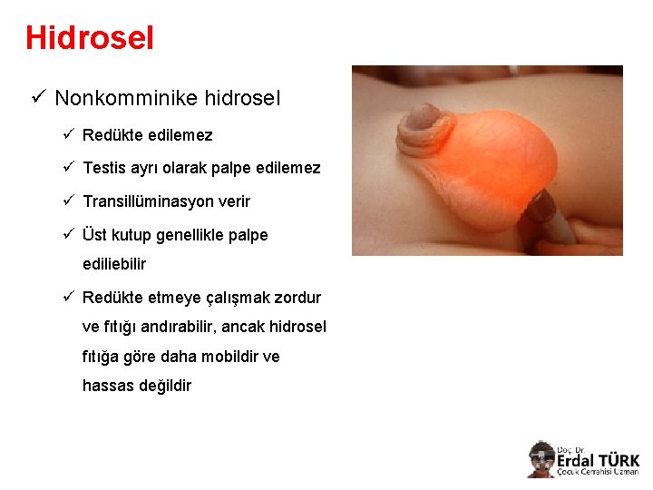 Hidrosel ü Nonkomminike hidrosel ü Redükte edilemez ü Testis ayrı olarak palpe edilemez ü