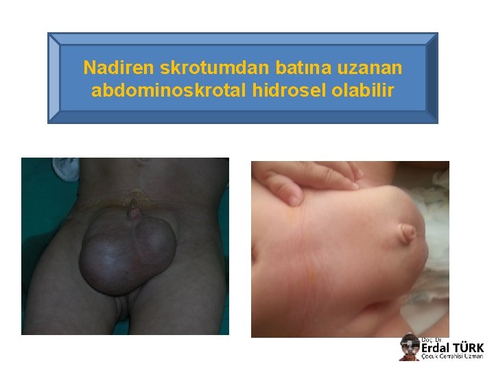 Nadiren skrotumdan batına uzanan abdominoskrotal hidrosel olabilir 