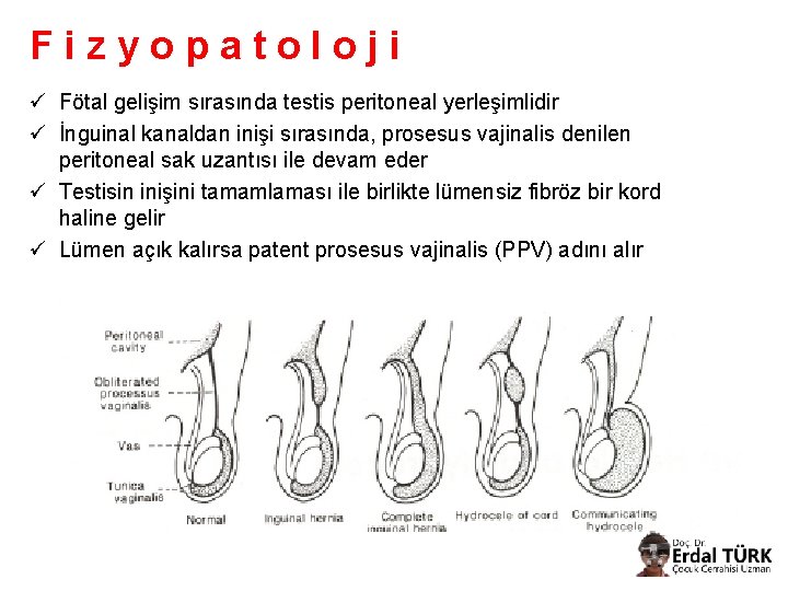 Fizyopatoloji ü Fötal gelişim sırasında testis peritoneal yerleşimlidir ü İnguinal kanaldan inişi sırasında, prosesus