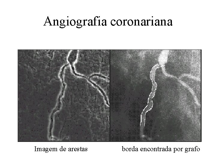 Angiografia coronariana Imagem de arestas borda encontrada por grafo 