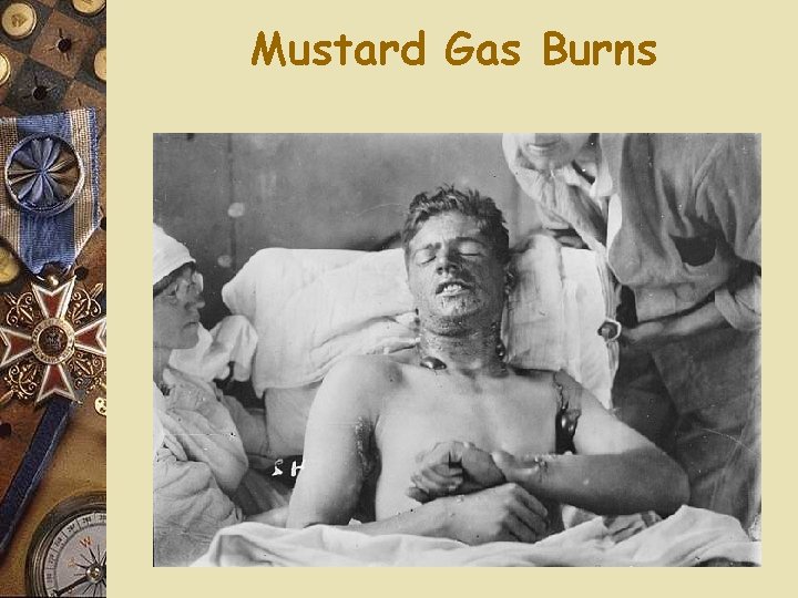 Mustard Gas Burns 