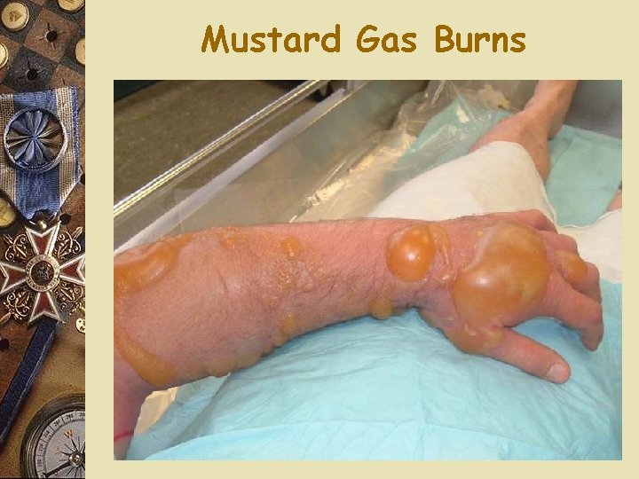 Mustard Gas Burns 