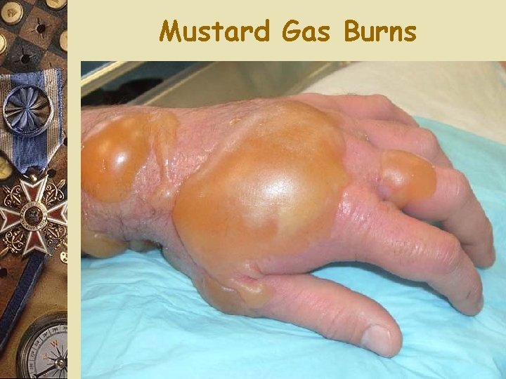 Mustard Gas Burns 