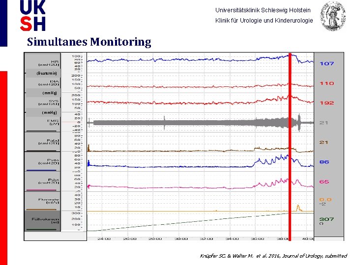 Universitätsklinik Schleswig Holstein Klinik für Urologie und Kinderurologie Simultanes Monitoring (Beats/min) (mm. Hg) Knüpfer