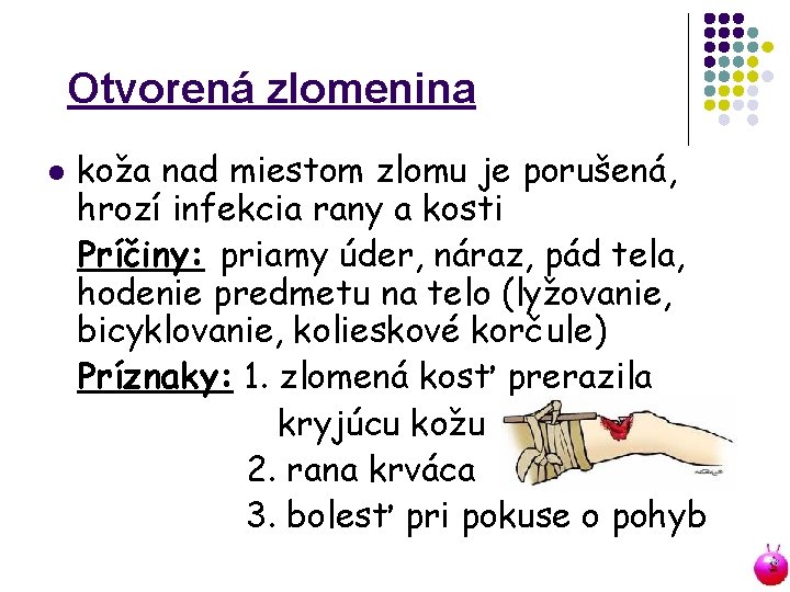 Otvorená zlomenina l koža nad miestom zlomu je porušená, hrozí infekcia rany a kosti