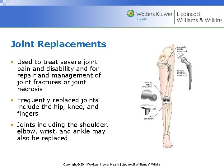 Joint Replacements • Used to treat severe joint pain and disability and for repair