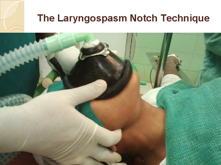 The Laryngospasm Notch Technique 