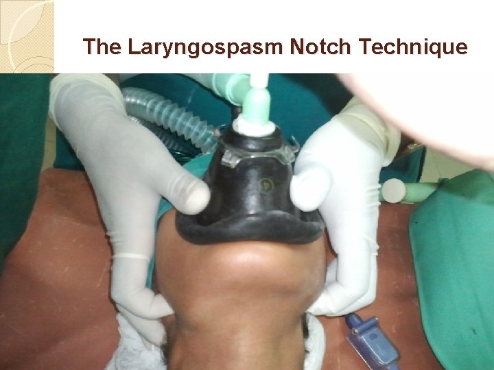 The Laryngospasm Notch Technique 