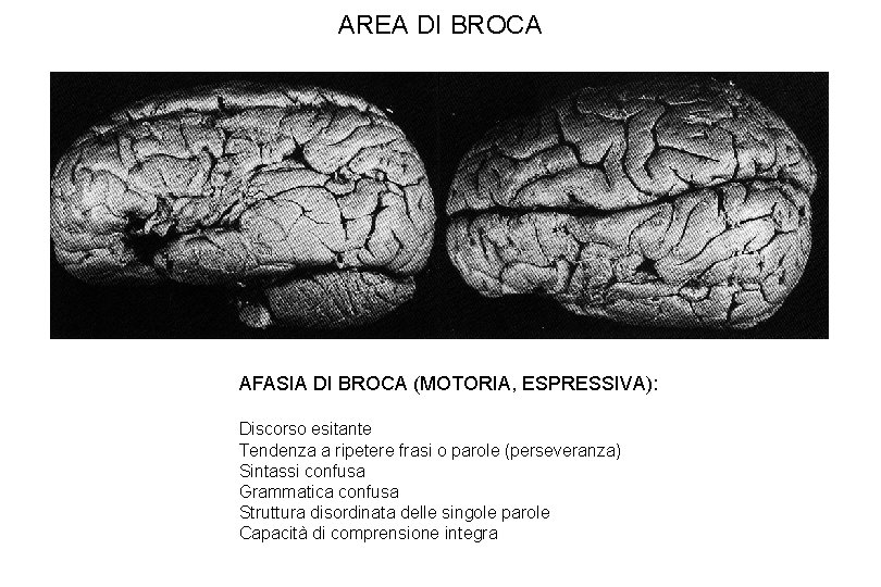 AREA DI BROCA AFASIA DI BROCA (MOTORIA, ESPRESSIVA): Discorso esitante Tendenza a ripetere frasi AREA DI BROCA AFASIA DI BROCA (MOTORIA, ESPRESSIVA): Discorso esitante Tendenza a ripetere frasi