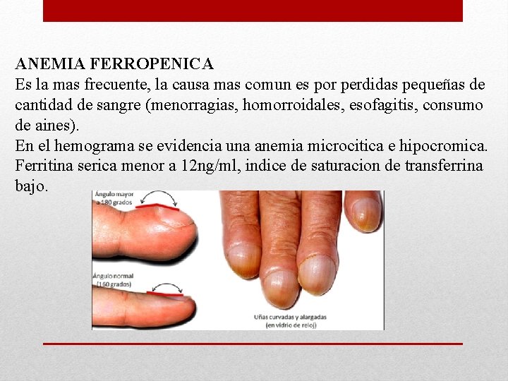 ANEMIA FERROPENICA Es la mas frecuente, la causa mas comun es por perdidas pequeñas ANEMIA FERROPENICA Es la mas frecuente, la causa mas comun es por perdidas pequeñas