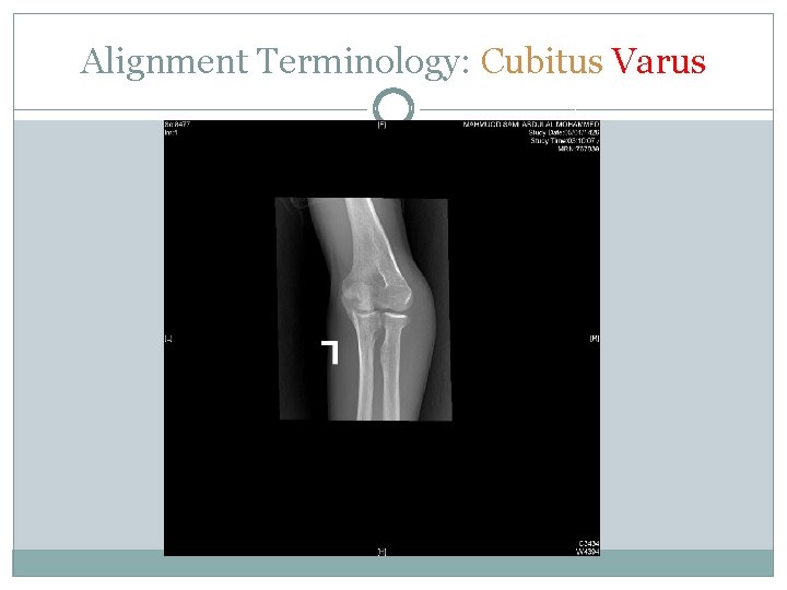 Alignment Terminology: Cubitus Varus 