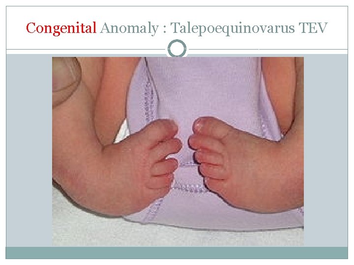 Congenital Anomaly : Talepoequinovarus TEV 