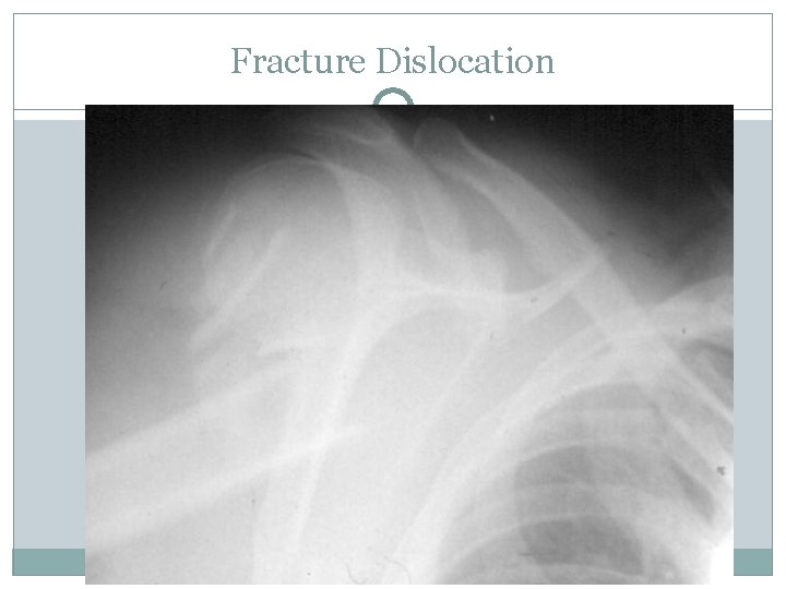 Fracture Dislocation 