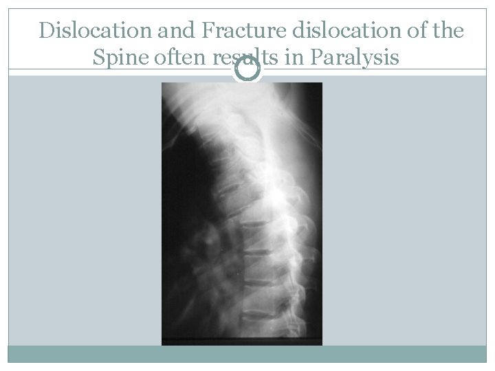 Dislocation and Fracture dislocation of the Spine often results in Paralysis 