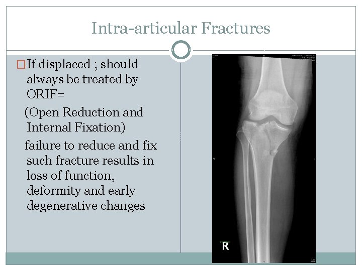 Intra-articular Fractures �If displaced ; should always be treated by ORIF= (Open Reduction and