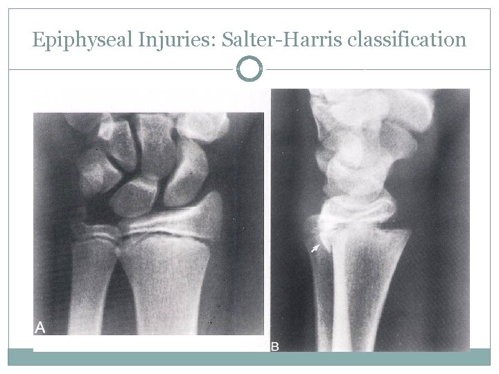 Epiphyseal Injuries: Salter-Harris classification 