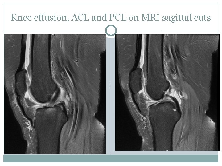 Knee effusion, ACL and PCL on MRI sagittal cuts 