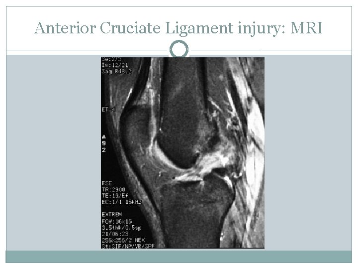 Anterior Cruciate Ligament injury: MRI 
