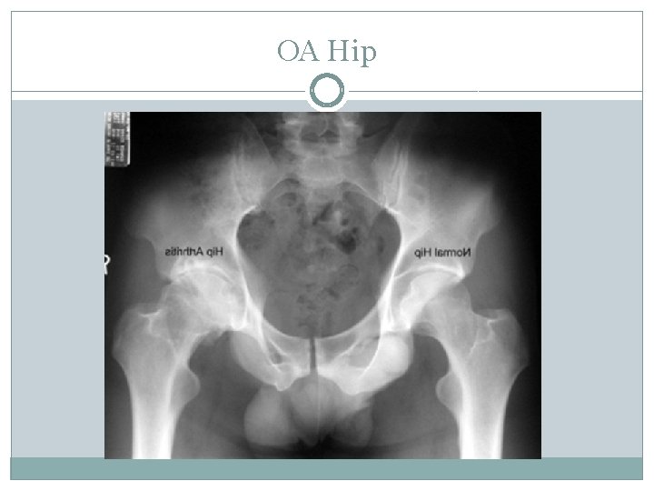 OA Hip 