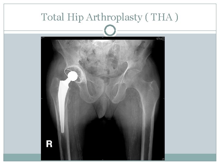 Total Hip Arthroplasty ( THA ) 