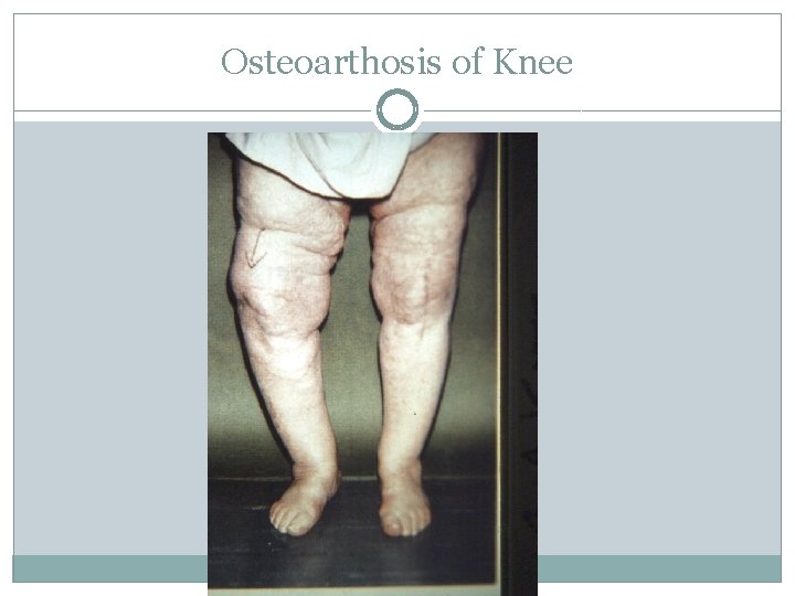 Osteoarthosis of Knee 