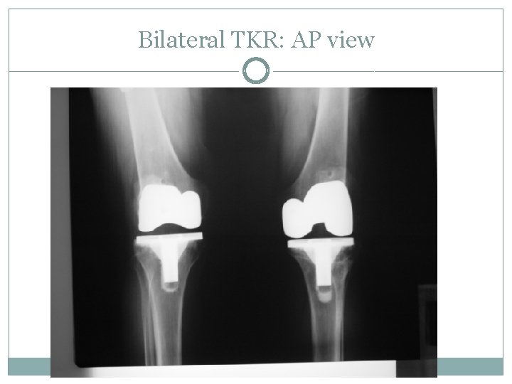 Bilateral TKR: AP view 