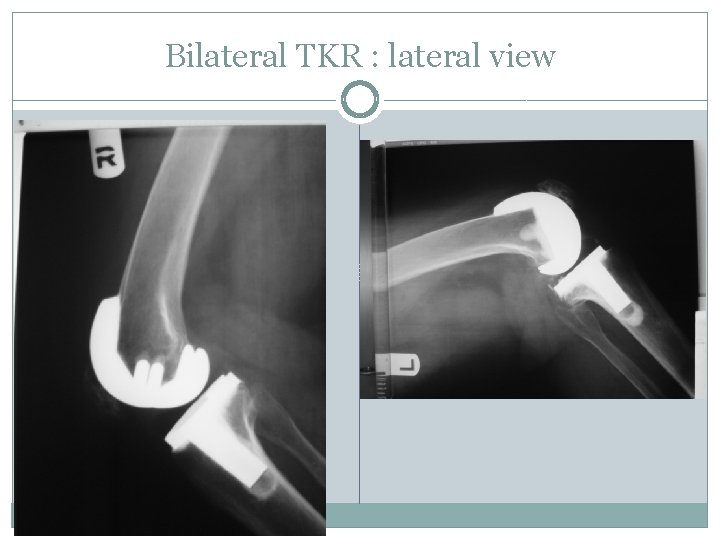 Bilateral TKR : lateral view 
