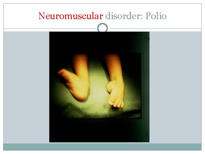 Neuromuscular disorder: Polio 