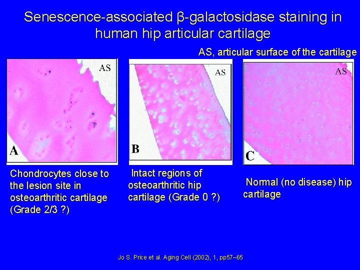 Senescence-associated β-galactosidase staining in human hip articular cartilage AS, articular surface of the cartilage