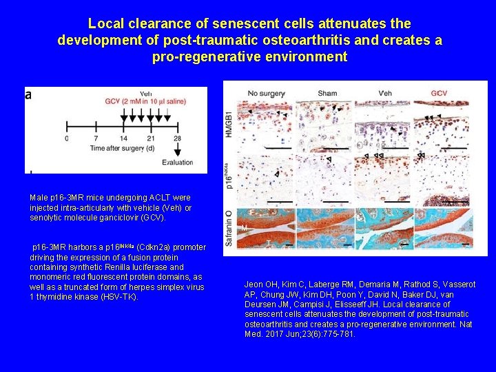 Local clearance of senescent cells attenuates the development of post-traumatic osteoarthritis and creates a