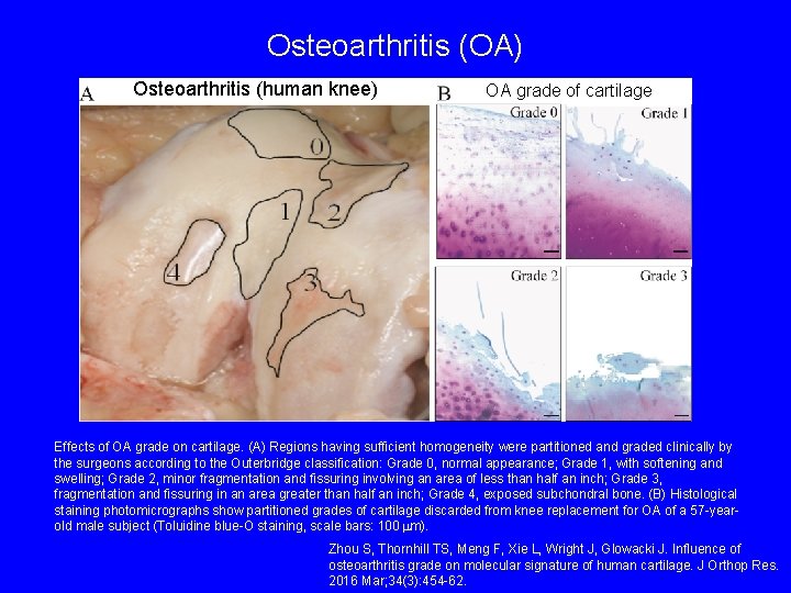 Osteoarthritis (OA) Osteoarthritis (human knee) OA grade of cartilage Effects of OA grade on