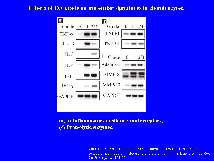 Effects of OA grade on molecular signatures in chondrocytes. (a, b) Inflammatory mediators and