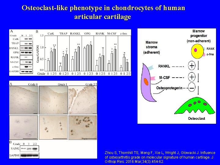 Osteoclast-like phenotype in chondrocytes of human articular cartilage Zhou S, Thornhill TS, Meng F,