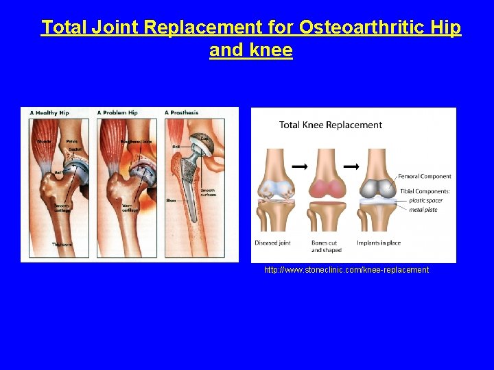 Total Joint Replacement for Osteoarthritic Hip and knee http: //www. stoneclinic. com/knee-replacement 