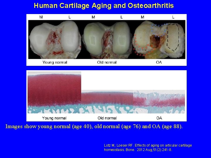Human Cartilage Aging and Osteoarthritis Images show young normal (age 40), old normal (age