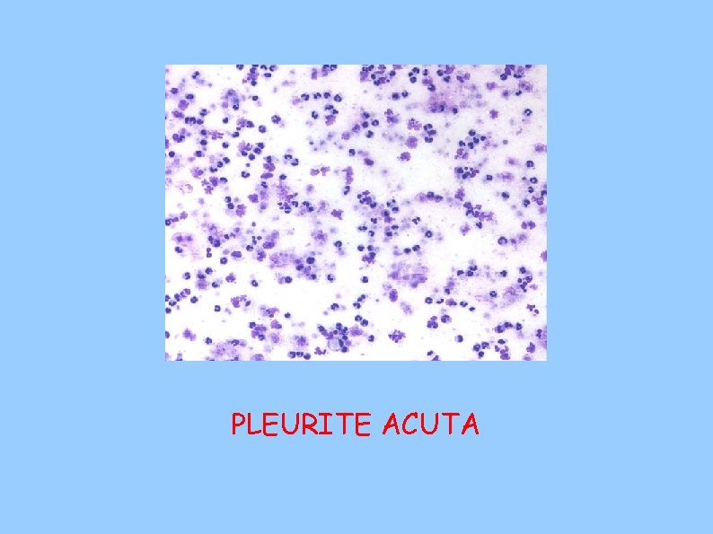 PLEURITE ACUTA 