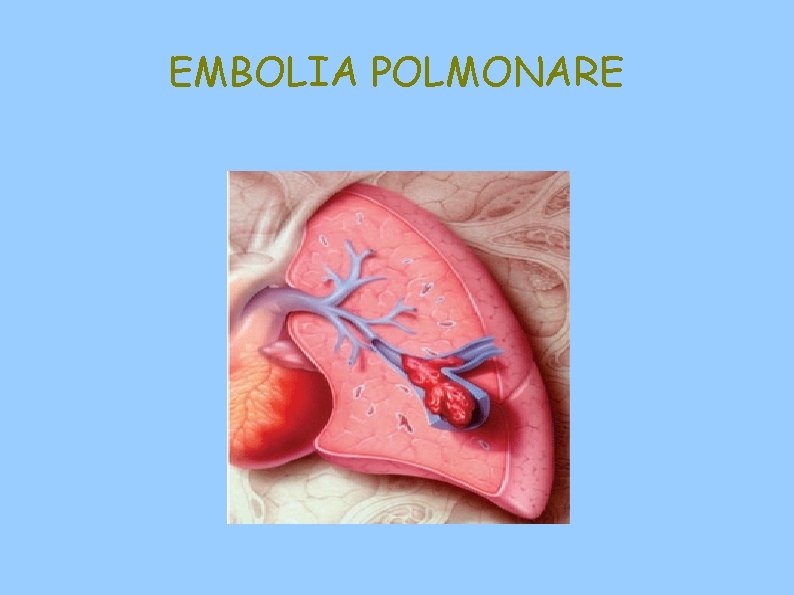 EMBOLIA POLMONARE 