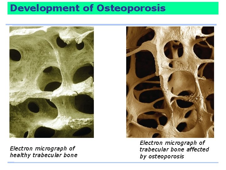 Development of Osteoporosis Electron micrograph of healthy trabecular bone Electron micrograph of trabecular bone