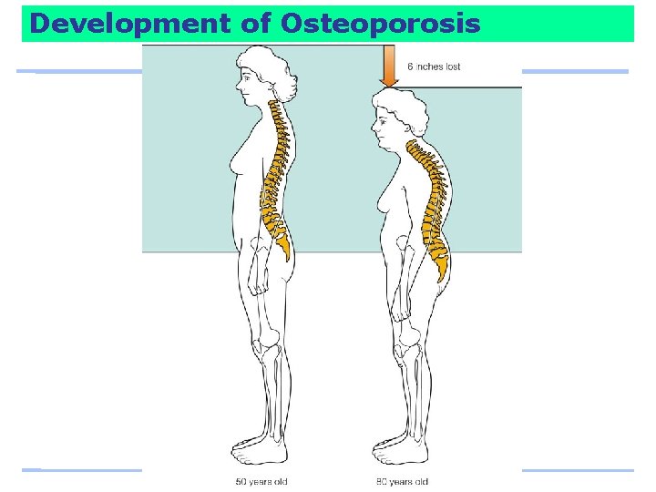 Development of Osteoporosis 