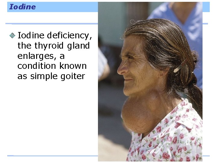 Iodine deficiency, the thyroid gland enlarges, a condition known as simple goiter 