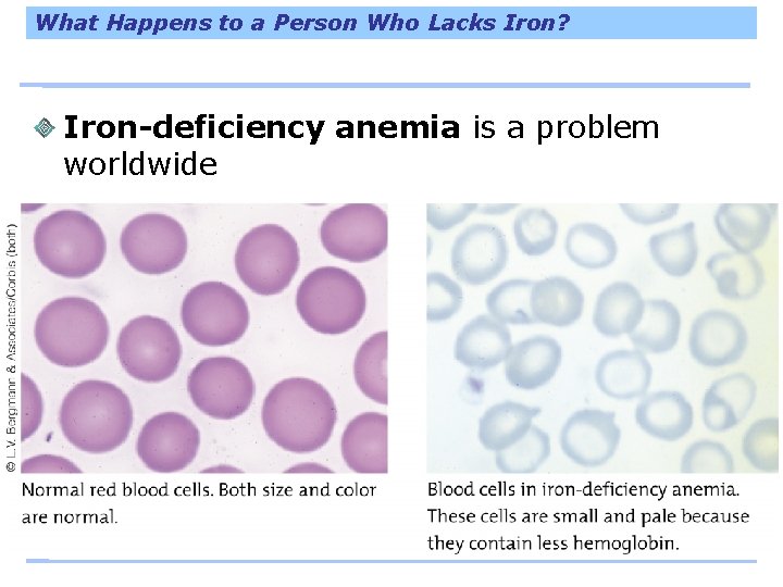 What Happens to a Person Who Lacks Iron? Iron-deficiency anemia is a problem worldwide