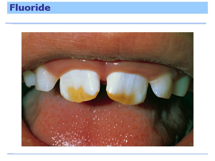 Fluoride 