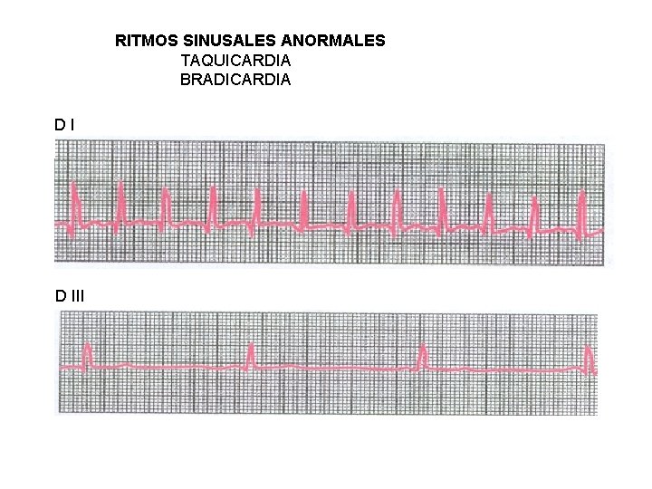 RITMOS SINUSALES ANORMALES TAQUICARDIA BRADICARDIA DI D III 