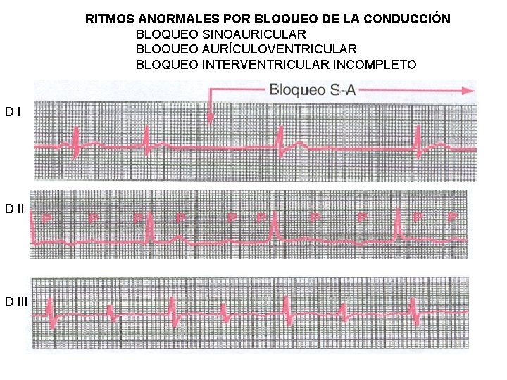 RITMOS ANORMALES POR BLOQUEO DE LA CONDUCCIÓN BLOQUEO SINOAURICULAR BLOQUEO AURÍCULOVENTRICULAR BLOQUEO INTERVENTRICULAR INCOMPLETO
