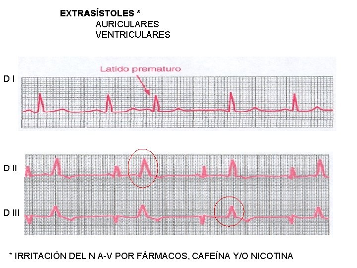 EXTRASÍSTOLES * AURICULARES VENTRICULARES DI D III * IRRITACIÓN DEL N A-V POR FÁRMACOS,