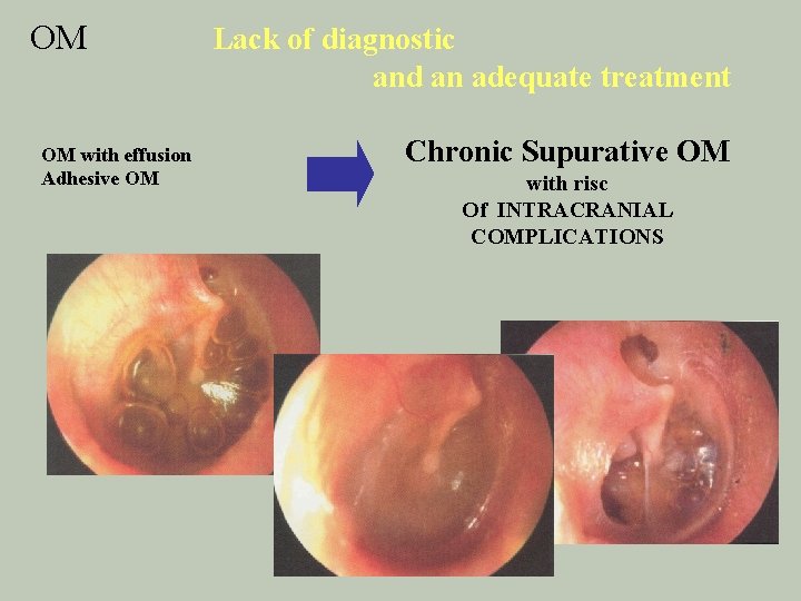 OM OM with effusion Adhesive OM Lack of diagnostic and an adequate treatment Chronic