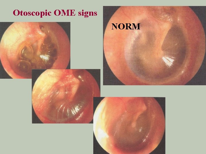 Otoscopic OME signs NORM 