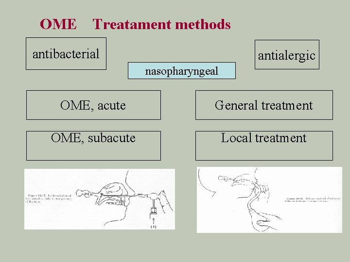 OME Treatament methods antibacterial antialergic nasopharyngeal OME, acute General treatment OME, subacute Local treatment